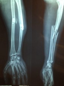 fracture bone 2333164 1920