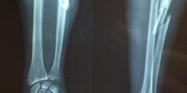 New Jersey workers’ compensation statute applies to employees and employers