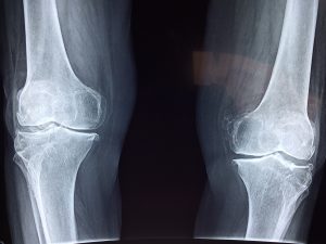 rodilla 2253047 1920